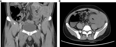 Case Report: Colon malignant tumor caused by retroperitoneal small round cell undifferentiated sarcoma